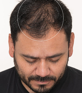 Hair Transformation